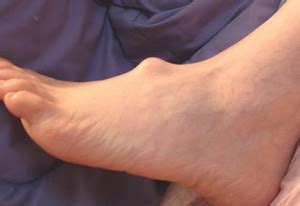 The linear measure was in old english (the exact length the current inch and foot are implied from measurements in 12c. ganglion cyst foot - The Tampa Podiatrist