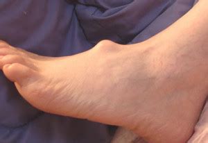 Фут → фут гунтера (межевой), surveyors' foot (ft). ganglion cyst foot - The Tampa Podiatrist