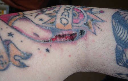 Riesgos De Los Tatuajes Alergias De Conadeip