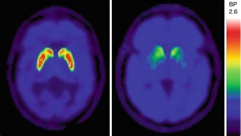 Parkinson Dementia Pet Findings Radiology Key