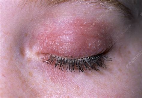 What Causes Eyelid Dermatitis Maybe You Would Like To Learn More