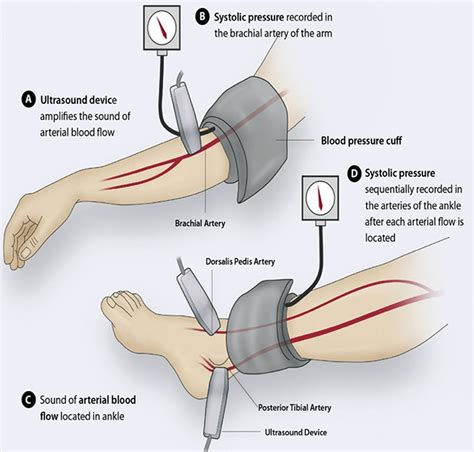 Peripheral Artery Disease Causes Symptoms And Treatment