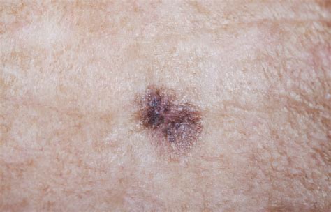 How Cancerous Moles Look Like Symptoms And Pictures