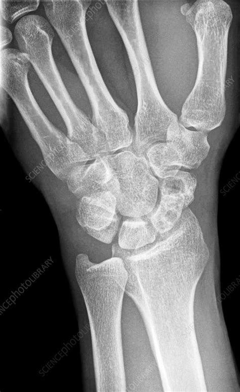 Fractured Scaphoid Wrist Bone X Ray Stock Image C Science Photo Library