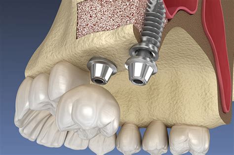 Eden Prairie Dentist Anderson Lake Dental Sinus Lift Surgery