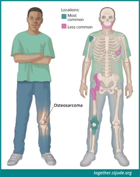 Osteosarcoma In Children And Teens Together