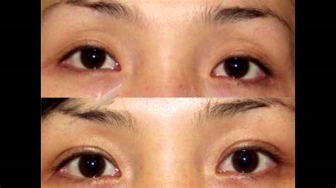 before after korean double eyelid surgery and ptosis correction at jw plastic surgery clinic in