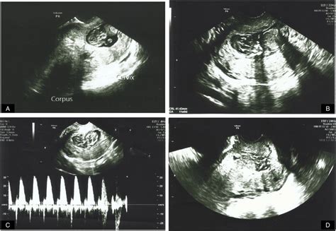 Cervical Ectopic Pregnancy Images On Transvaginal Ultrasound A Empty