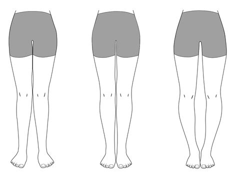 Bow Legs And Knock Knees In Children Information For Referrers