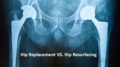 Hip Replacement Vs Hip Resurfacing Hip Resurfacing Hip Replacement Total Hip Replacement