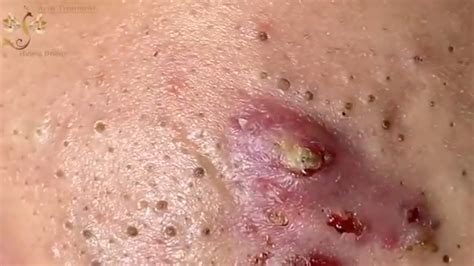 Satisfying Blackheads Removal 9 Youtube
