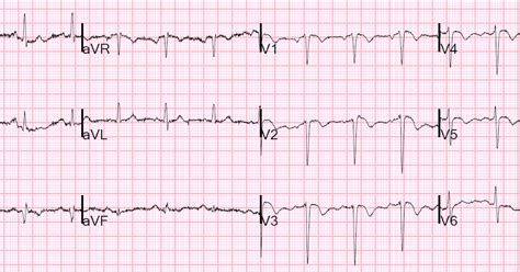 Dr Smiths Ecg Blog Are These Wellens Waves