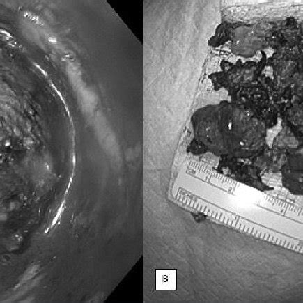 Clogged Large Debris Within Fully Covered Metal Stent A And Removed