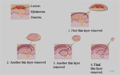 Treatment Of Skin Cancer By Surgery Download Scientific Diagram