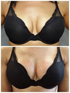 The Vampire Breast Lift A Non Surgical Solution For Breast Enhancement