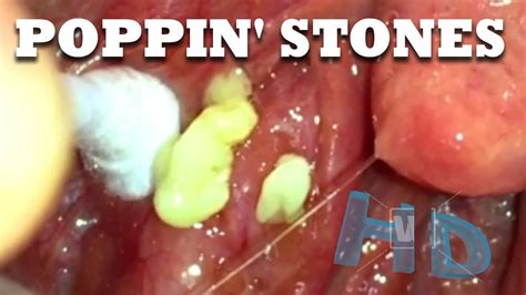 Tonsil Stones Tonsilloliths And Tonsillitis Plus Teeth Whitening Youtube