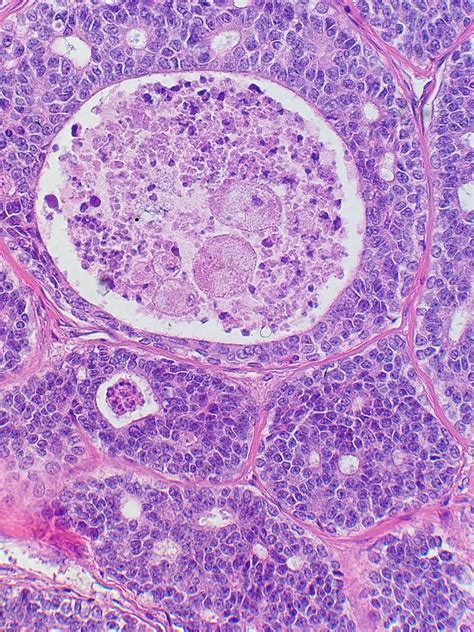 Adenoid cystic carcinoma (acc) is a relatively common malignant neoplasm that mainly affects the minor salivary glands in various regions, including the palate. File:Adenoid cystic carcinoma with comedonecrosis.jpg ...