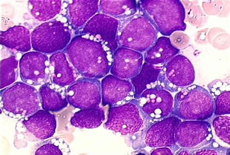 Bl Cells With Basophilic Cytoplasm Round Nuclei With Coarse