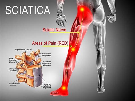 Pain Areas Of The Back Back Pain Causes Exercises Treatments Versus