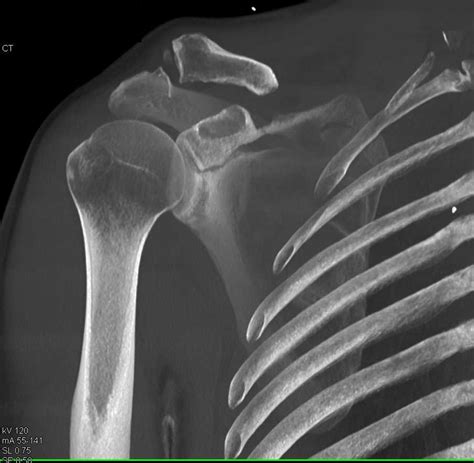 Glenoid Fracture And Widening Of The Ac Joint Musculoskeletal Case