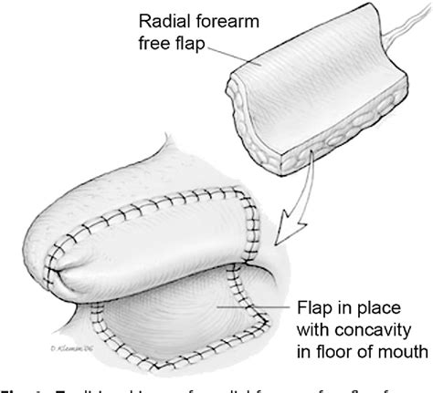 Figure From Ideas And Innovations Maximizing Flap Inset For Tongue