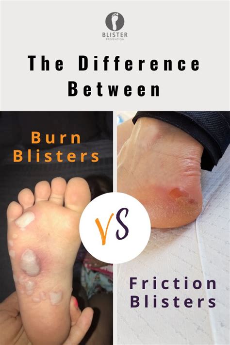 Burn Blister Vs Friction Blister Blister Prevention Hand Blister