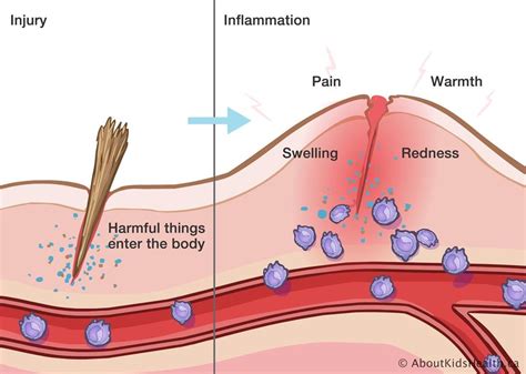 The Inflammatory Process And How To Use It To Our Benefit — Brill
