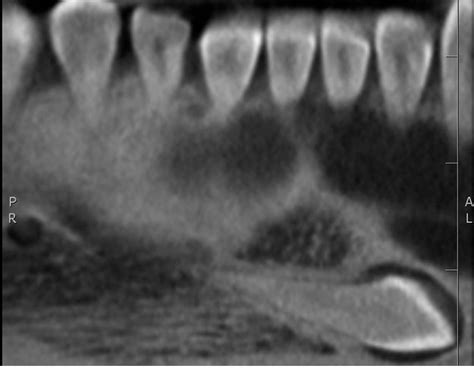 Figure 1 From Spontaneous Regression Of A Dentigerous Cyst Associated