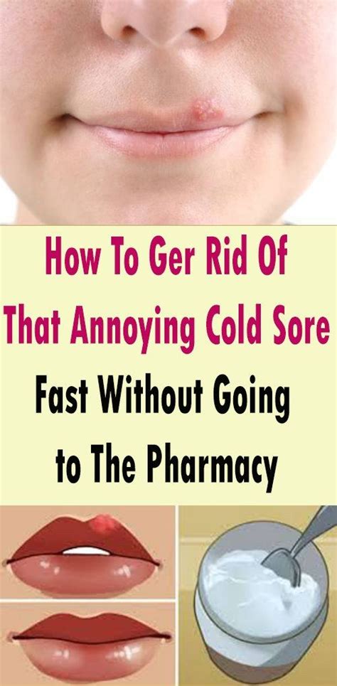 How To Ger Rid Of That Annoying Cold Sore Fast Without Going To The