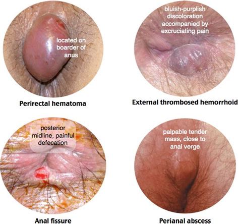 Hemorrhoids can either be internal or external. Pin on GI rotation