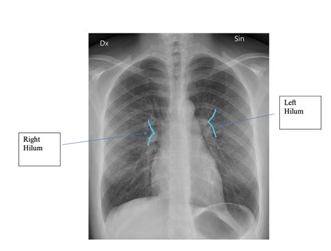 Hilum Of The Lung Geeky Medics