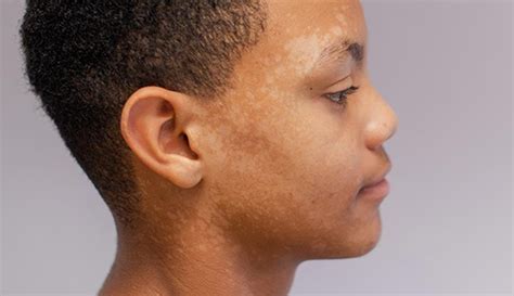 African American Skin Discoloration Light Spots