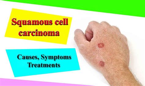 Squamous Cell Carcinoma Causes Symptoms Treatments And Risk Factors