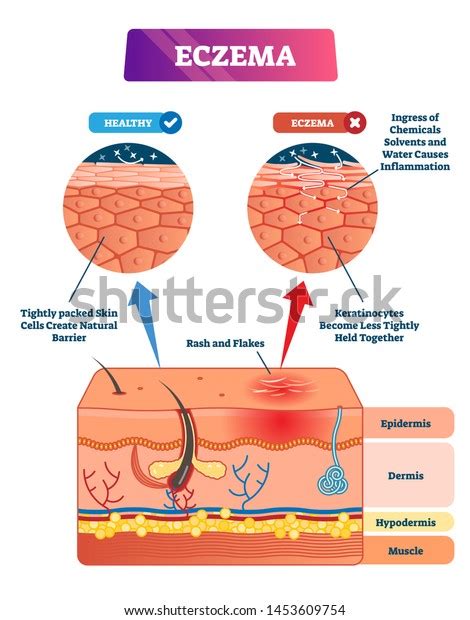 Eczema Vector Illustration Labeled Anatomical Structure Stock Vector