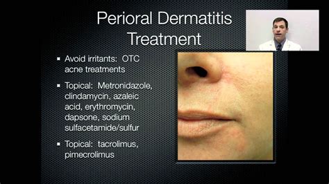 Perioral Dermatitis Treatment Onlinedermclinic Youtube