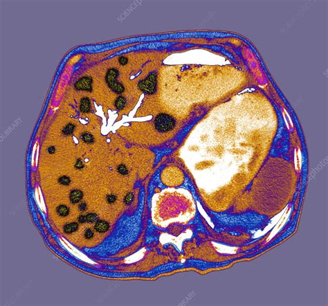 Liver Cancer Ct Scan Stock Image M1750397 Science Photo Library