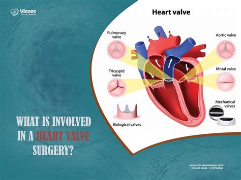 What Is Involved In A Heart Valve Replacement Surgery
