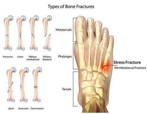 Some folks don't mind making individual ajax requests. Metatarsal Foot stress fractures | General Discussion ...