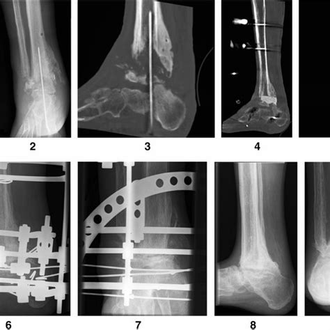 2 3 Patient 2—a 61 Year Old Patient With Previous Weber C Fracture