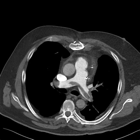 Clinical Concepts In Ct Imaging Of The Chest — Taming The Sru