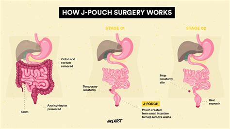 What Is J Pouch Surgery Procedure Stages
