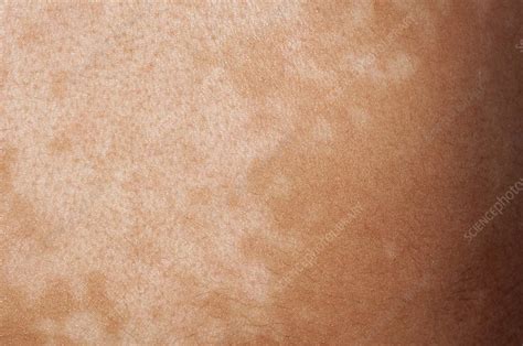 Pityriasis Versicolor Skin Infection Stock Image C Hot Sex Picture