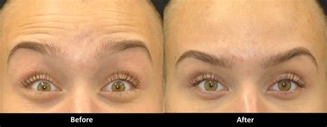 Fix Heavy Eyebrows After Botox