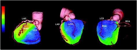 Clinical Myocardial Perfusion Petct Journal Of Nuclear Medicine