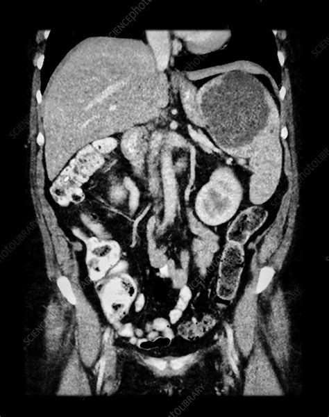 Ct Of Splenic Cyst Stock Image C0430397 Science Photo Library