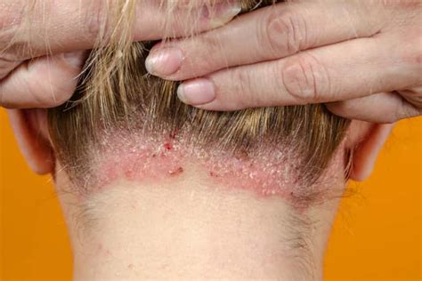 Scabs And Sores On Scalp 17 Causes Pictures And Treatment