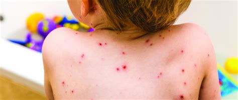 Chickenpox Symptoms Treatment And Vulnerable Groups Nursing In Practice