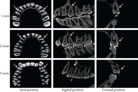 Cbct Images Showing Root Types Of Maxillary First Premolars Arrows