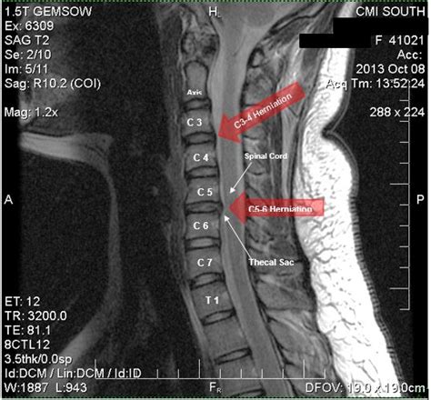 Herniated Disc Settlements Car Accidents And More