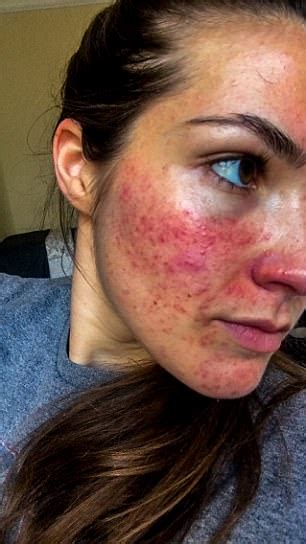 Womans Rosacea Treated With Flowers Daily Mail Online